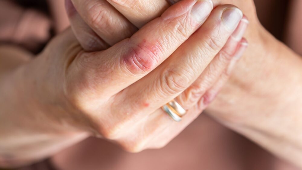 Atopowe zapalenie skóry – jak sobie z nim radzić?